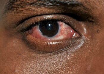 Conjunctivitis (pink eye) affects the outer membrane of the eyeball and the inner eyelid. PHOTO: SUPPLIED