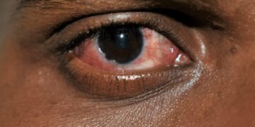 Conjunctivitis (pink eye) affects the outer membrane of the eyeball and the inner eyelid. PHOTO: SUPPLIED